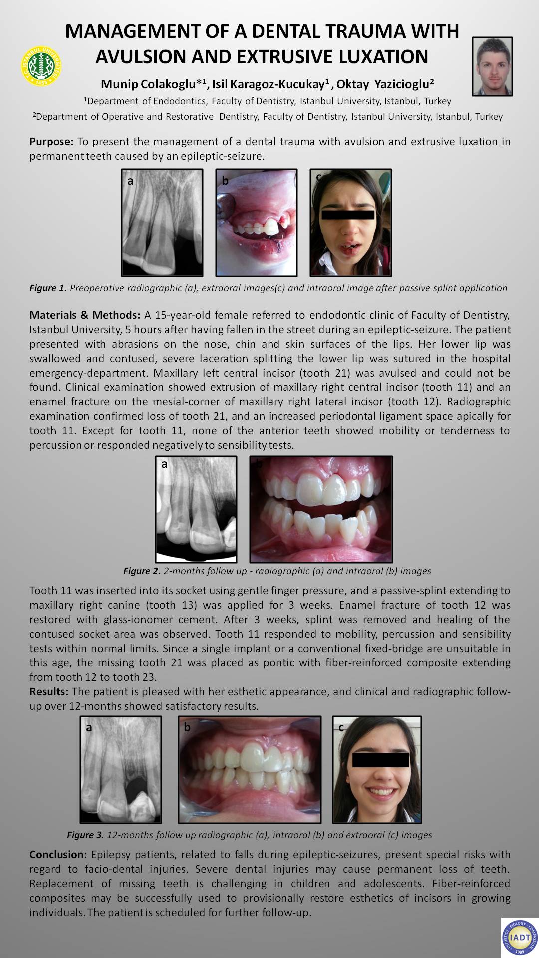 tooth luxation